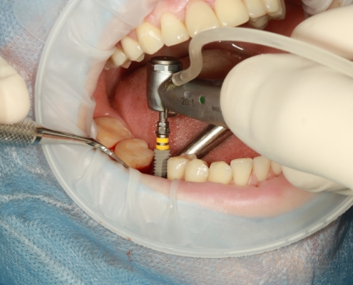 Implantate