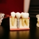 implantate