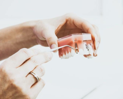 Implantat als Zahnersatz