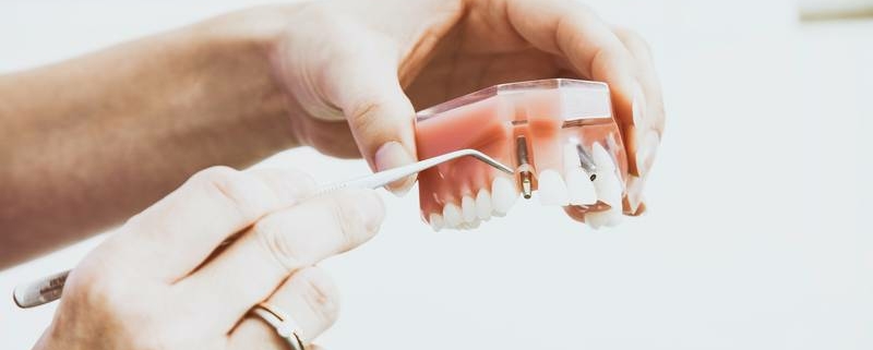 Implantat als Zahnersatz