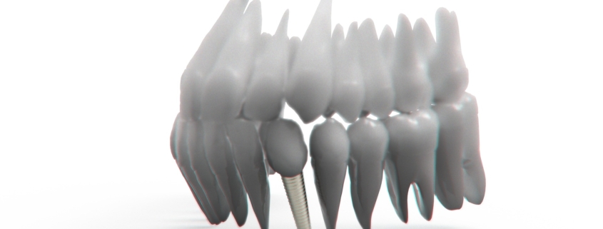 Osteoporose